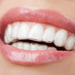 Group logo of Braces vs Clear Aligners — Which Is Better